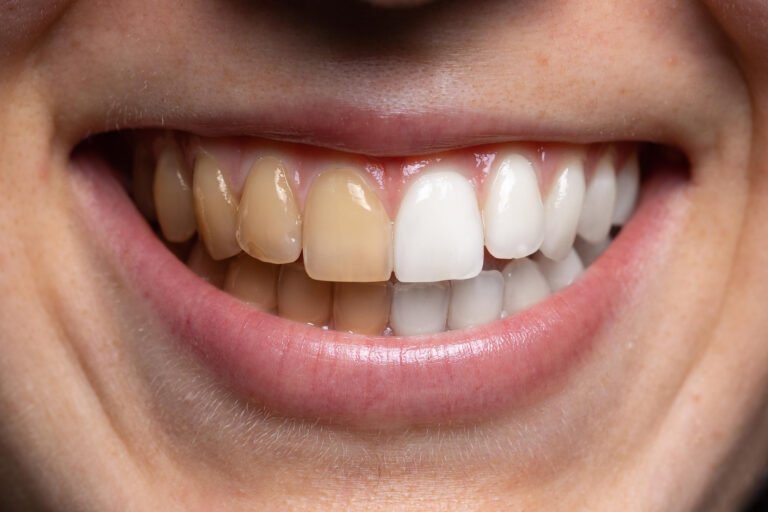 Recupera el brillo natural de tu sonrisa: Tratamientos de desmanchado dental en Kobe, Monterrey