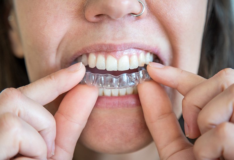 alineadores dentales en monterrey